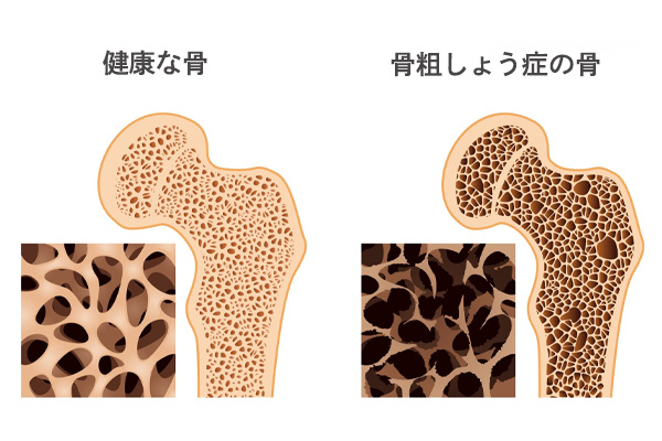 骨粗しょう症外来