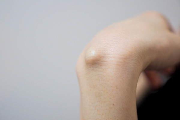 身体にできた「こぶ」「しこり」